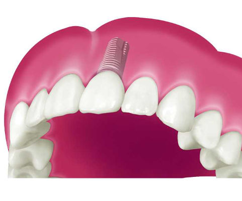 Zahnersatz auf Implantaten